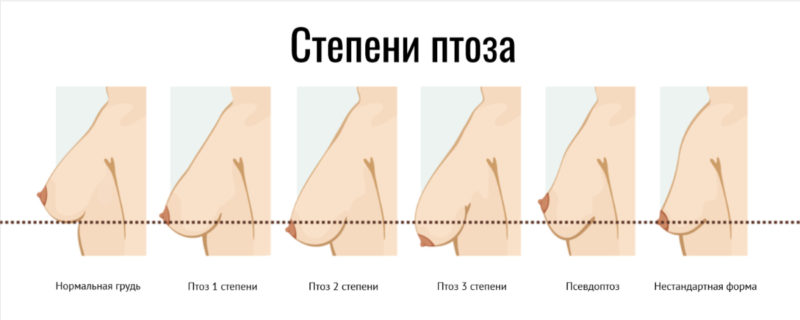 Фото До и После подтяжки груди Степени и виды птоза