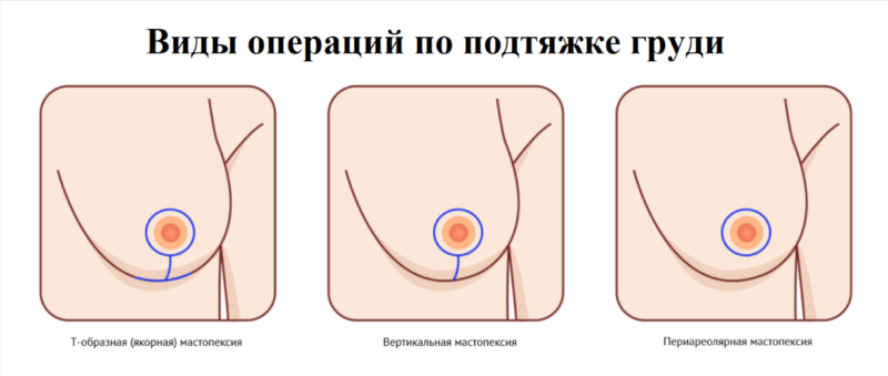 Виды операций по подтяжке груди Виды операций по подтяжке груди