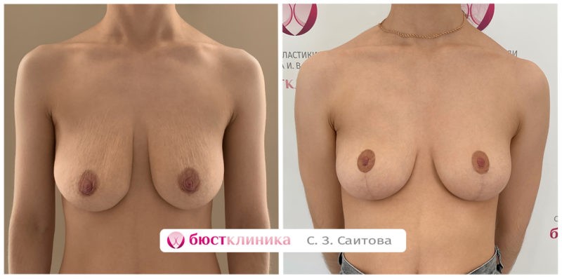 Увеличение груди в Бюстклиника Увеличение груди в Бюстклиника