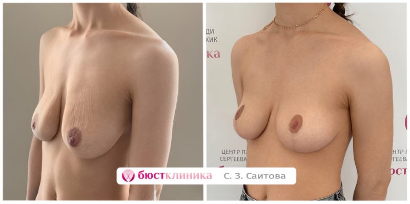 Увеличение груди в Бюстклиника Увеличение груди в Бюстклиника