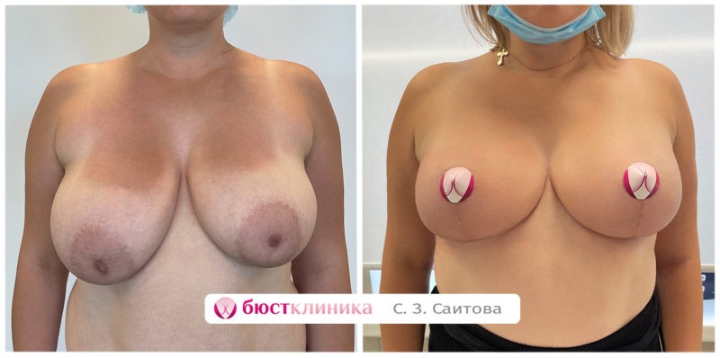На фото результат до и после операции по уменьшению груди