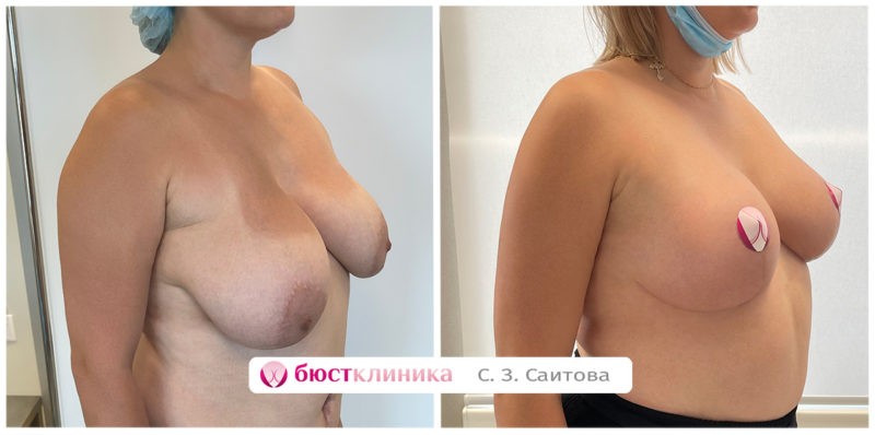 На фото результат до и после операции по уменьшению груди